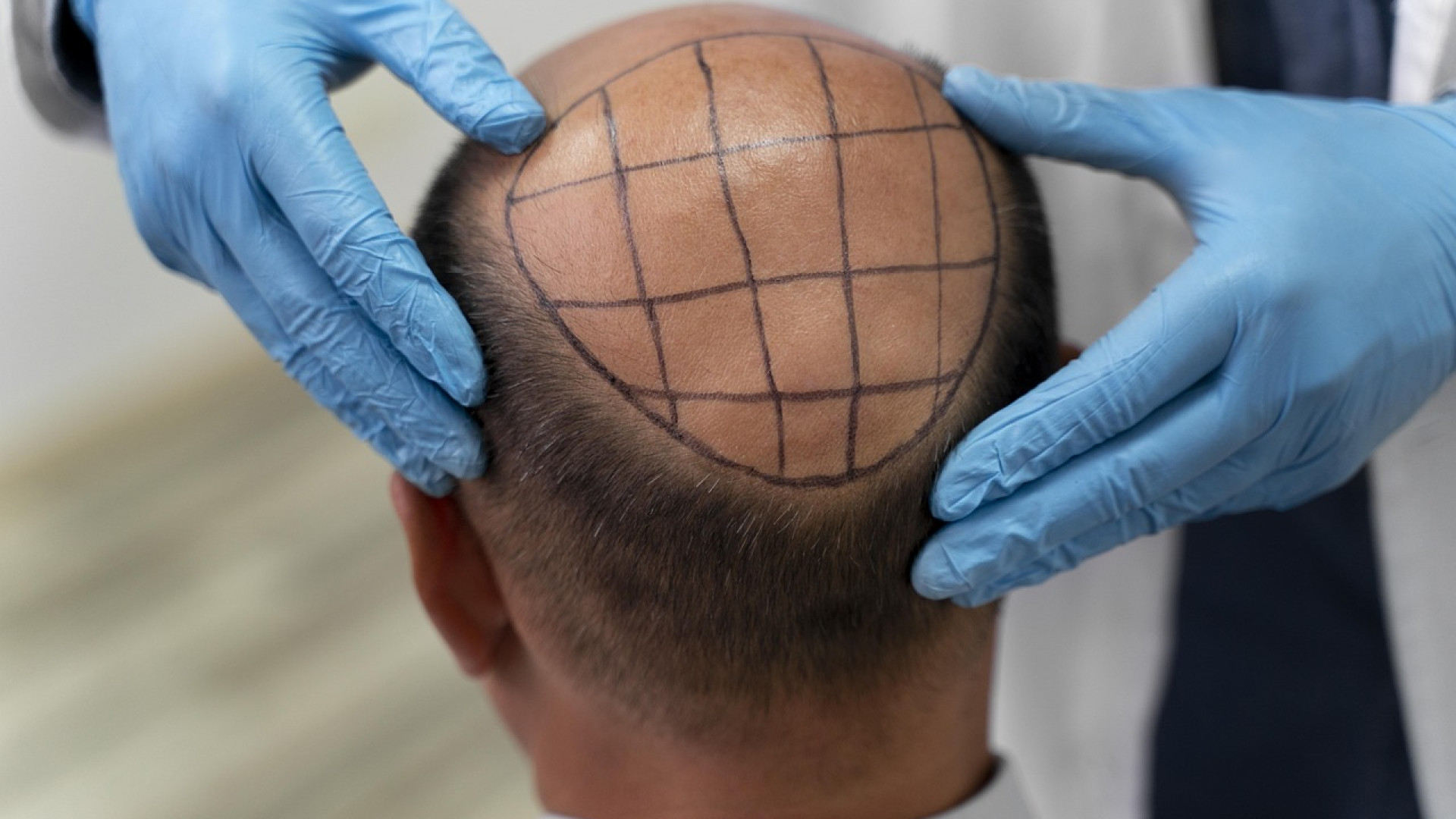 Le renouveau capillaire : zoom sur la greffe de cheveux dans la médecine esthétique